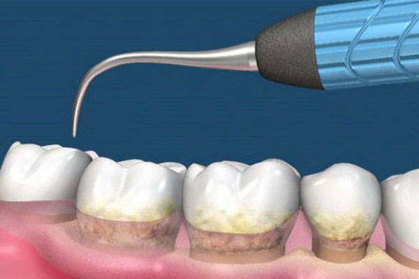 洁牙后的牙缝会被牙龈填满吗(洁牙后的牙缝会被牙龈填满吗)