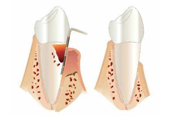 根管治疗相隔几天做第二次可以吗(根管治疗相隔几天做第二次可以吗)