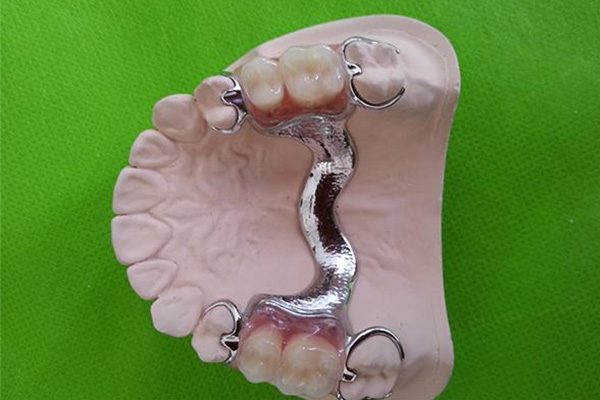 树脂和全瓷牙哪个好(全瓷牙和树脂牙哪个好)