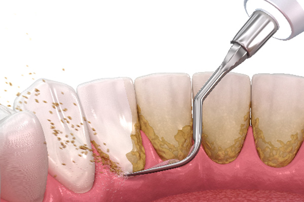 牙齿发黄用什么牙膏最好(儿童牙齿发黄用什么牙膏最好)