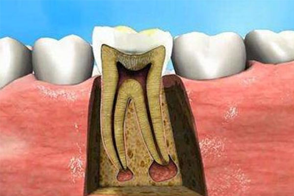 牙齿脱敏凝胶多少钱一支(牙齿脱敏凝胶的副作用)