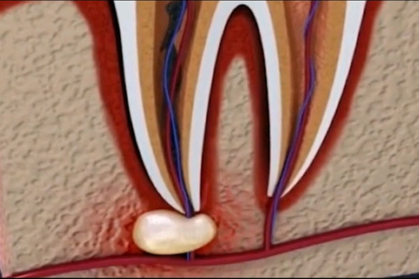 牙体缺损粘接修复术是按洞算还是颗算(牙体缺损粘接修复术是不是补牙)
