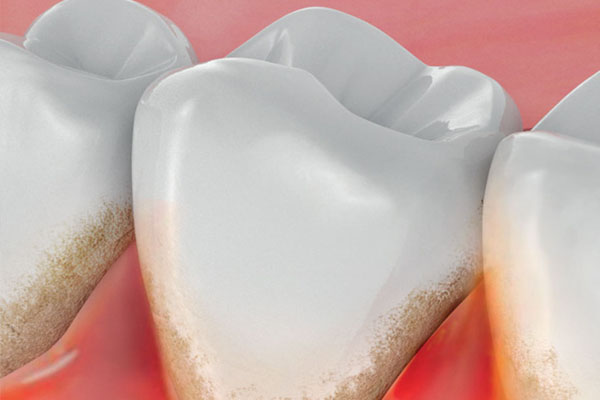 早上起来牙齿上有褐色分泌物和黄色分泌物(早上起来牙齿上有褐色分泌物和黄