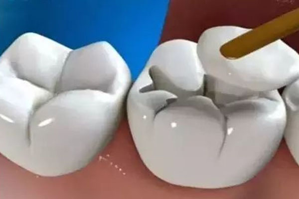 什么时候要做窝沟封闭(什么时候要做窝沟封闭治疗)