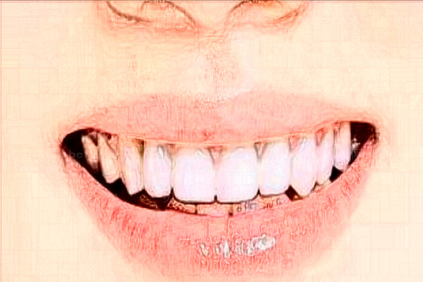 牙科美白剂灼伤皮肤怎么办呢(牙科美白剂灼伤皮肤怎么办呢)