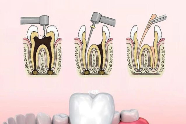 什么是牙齿根管治疗需要多久