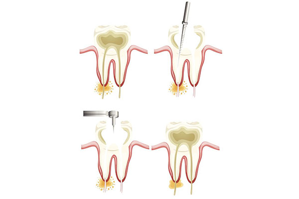 医疗保险可以报销根管治疗的钱吗(医疗保险可以报销根管治疗的钱吗多少)