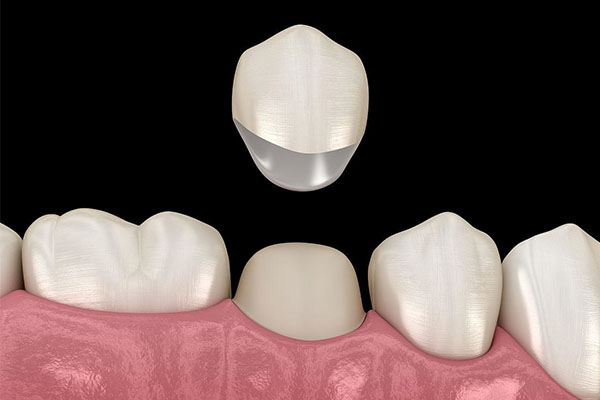 瓷贴面修复的禁忌症错误的是(瓷贴面修复适应症)