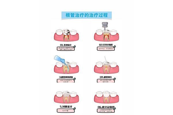 根管治疗费用报销标准最新(根管治疗费用报销标准最新文件)