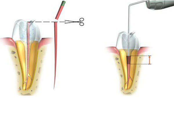 三甲医院根管治疗费用医保报销吗多少钱(三甲医院根管治疗费用医保报销吗多