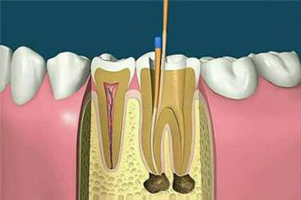 天津牙根管治疗医保卡报销吗(天津牙根管治疗医保卡报销吗多少钱)