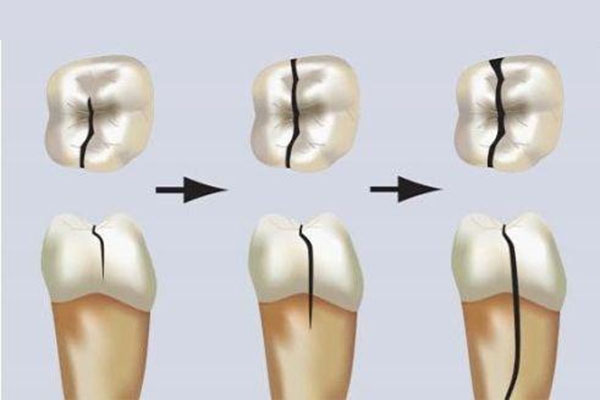门牙缺损会影响财运吗(门牙缺失会影响运气吗)