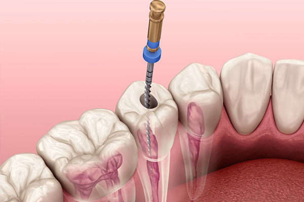 做根管治疗一般要去几次医院呢(做根管治疗一般要去几次医院呢)