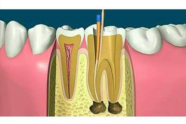 做完根管可以不安牙冠吗(做完根管后可以不补牙吗)