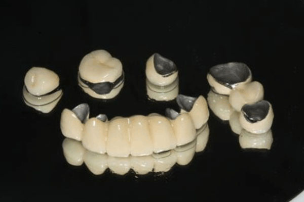 烤瓷牙和烤瓷牙套的区别是什么意思(烤瓷牙和烤瓷牙套的区别是什么意思图片