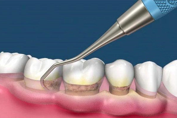 牙齿刷出来黄色(牙齿刷出来黄色的东西)