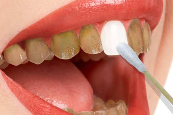 满口黄牙是什么意思呀网络用语怎么说(满口黄牙是什么意思呀网络用语怎么说