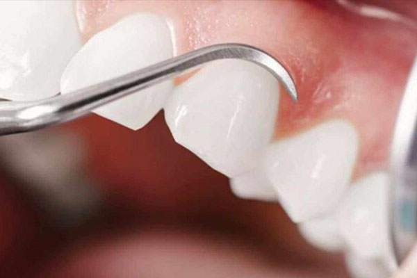 做了牙齿贴面非常后悔怎么办呢吃什么药(做了牙齿贴面非常后悔怎么办呢吃什