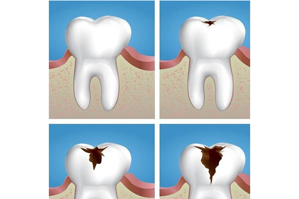 补牙后材料掉了怎么办(补牙后材料掉了怎么办小妙招)