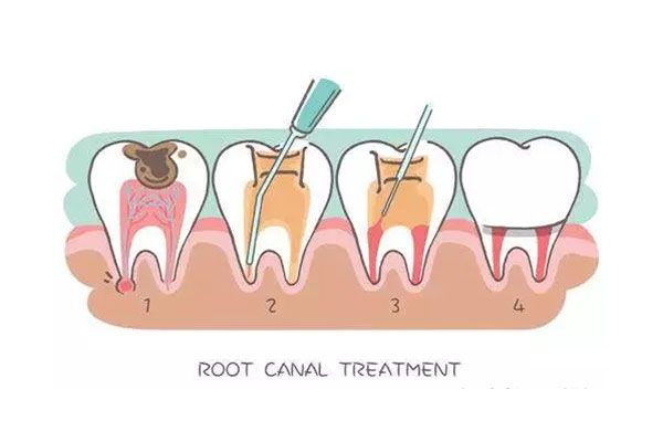 黄牙齿怎么去除最快(黄牙齿怎么去除最快的方法)