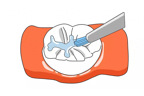 乳牙的窝沟封闭要做几颗牙冠(乳牙的窝沟封闭要做几颗牙冠好)