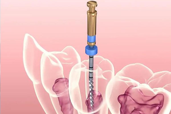 根管治疗在诊所做安全么(根管治疗在诊所能做吗)