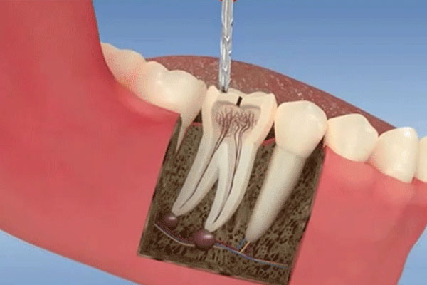 牙体缺损粘结修复术收费(牙体缺损粘结修复术收费多少)