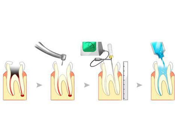 怎么知道根管治疗成功(怎么知道根管治疗成功没)