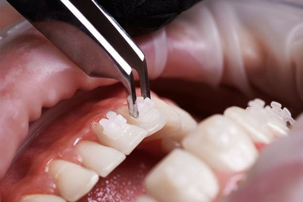 牙龈处牙齿缺损是怎么回事啊吃什么药(牙龈处牙齿缺损是怎么回事啊吃什么药