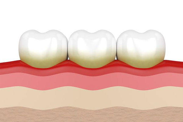 牙黄用什么可以变白(牙黄用什么变白的偏方)