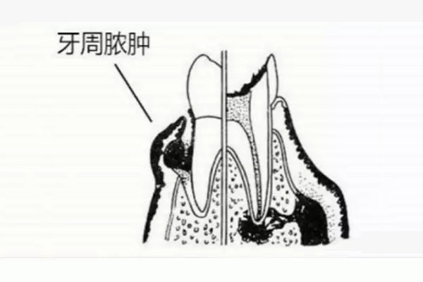 牙周炎用什么中药治疗效果最好(牙周炎用什么中药最见效)