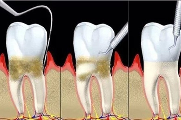 牙黄是一种病吗(牙黄是一种病吗怎么治疗)