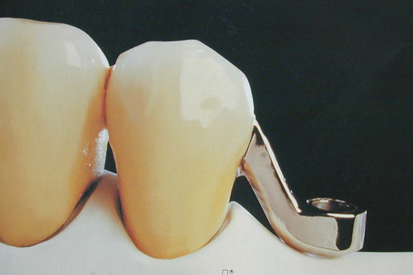 牙龈处牙齿缺损是怎么回事儿啊吃什么药(牙龈处牙齿缺损是怎么回事儿啊吃什