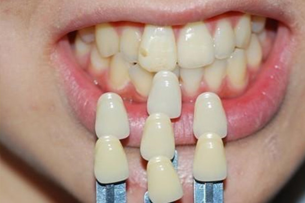 铸瓷贴面牙齿的优缺点有哪些(铸瓷贴面牙齿的优缺点有哪些图片)