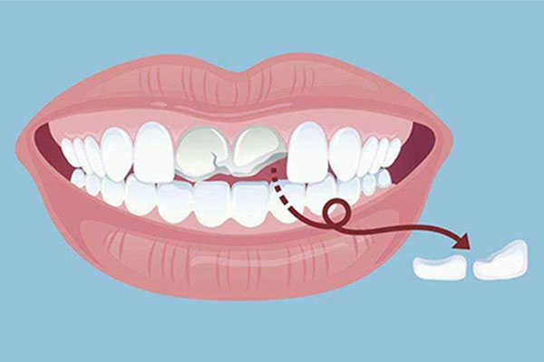 牙体缺损修复的修复体种类(牙体缺损修复体的种类有哪些)