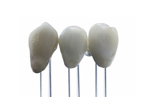 牙缝贴面怎么做(牙缝贴面怎么做视频)