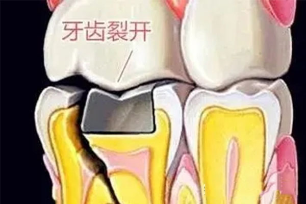 牙体缺损修复的基本流程包括哪些(牙体缺损修复的基本流程包括哪些步骤)