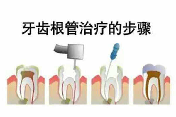 小孩做根管治疗要去多少次才能好(小孩做根管治疗要去多少次才能好起来)