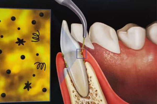 牙黄刷不干净是什么原因造成的怎么治疗(牙黄刷不干净是什么原因造成的怎么