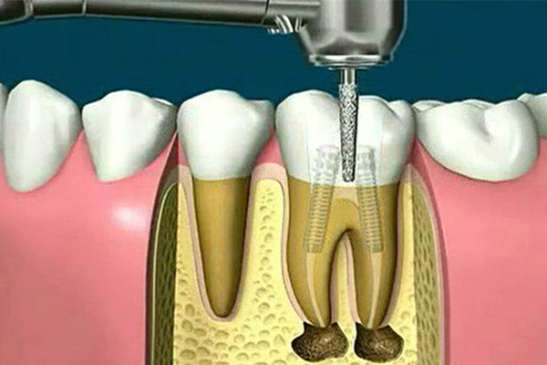 根管治疗后的牙齿发炎疼痛(根管治疗后的牙齿发炎疼痛正常吗)