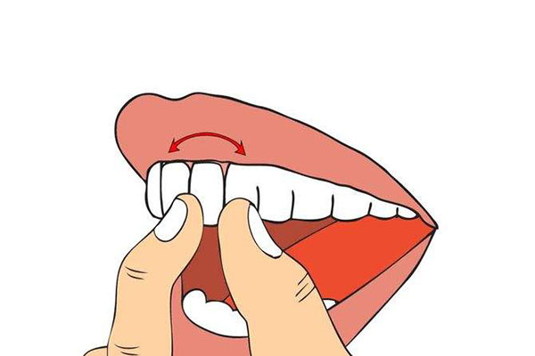 牙贴面和烤瓷牙冠的区别是什么意思(牙贴面和烤瓷牙冠的区别是什么意思图片