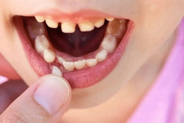 牙齿缺损多少才需要做牙冠(牙齿缺损多少才需要做牙冠矫正)