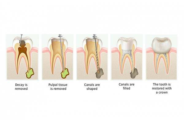 牙医说要做根管治疗什么意思(牙医说要做根管治疗什么意思呢)