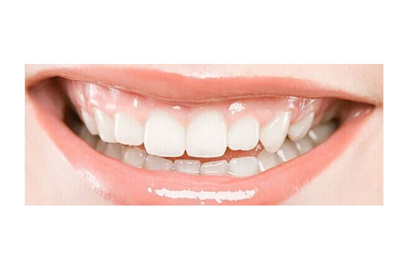 牙缝之间有黑色的东西怎么去除干净(牙缝之间有黑色的东西怎么去除干净图片