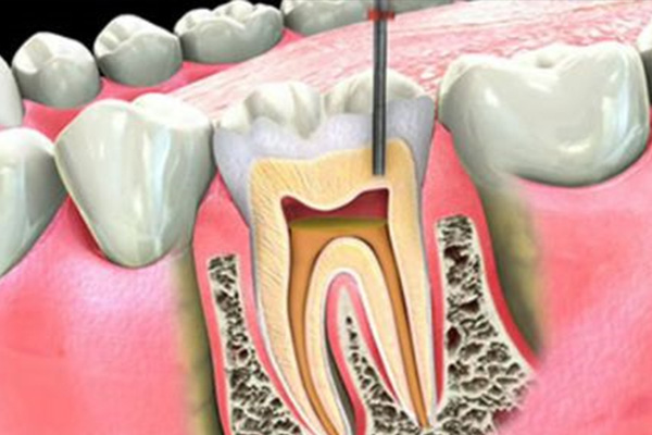 牙根发炎做根管几次能好(牙根发炎做根管几次能好转)
