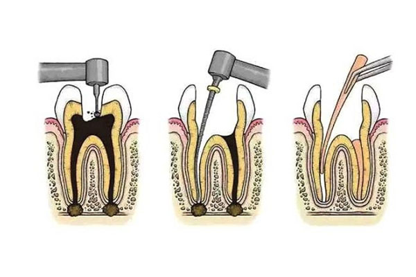 根管一定要杀神经吗(根管一定要杀神经吗图片)