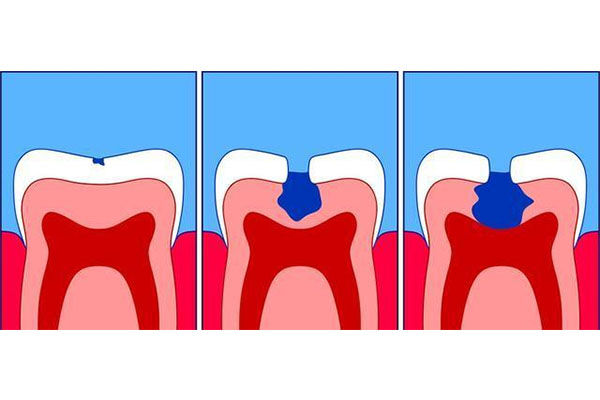 虫牙掉了一大半怎么办啊吃什么药好(虫牙掉了一大半怎么办啊吃什么药好得快
