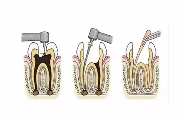 根管治疗最快多久完成啊(根管治疗最快多久完成啊图片)