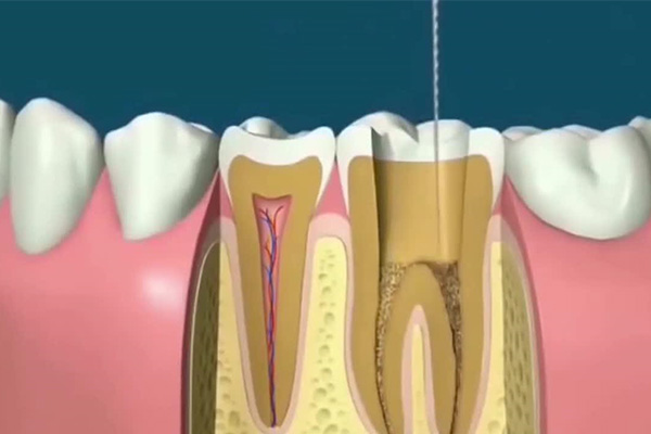 北京哪个医院根管治疗报销比例高(北京哪个医院根管治疗报销比例高一点)