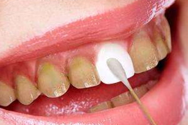 牙垢牙黄选什么牙膏比较好一点(牙垢牙黄选什么牙膏比较好一点儿)